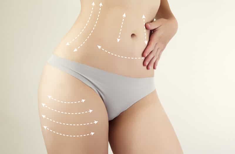 Photograph showing the slimmed-down waistline of a JL Prado Surgical Center patient post-cosmetic surgery